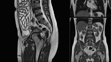 ERCP - ендоскопска ретроградна холангиопанкреатография