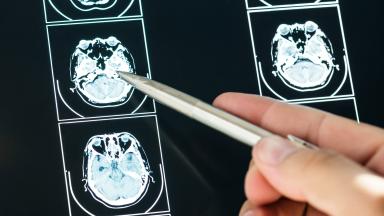 Dotatate PET/CT скенер - образна диагностика на невроендокринни тумори