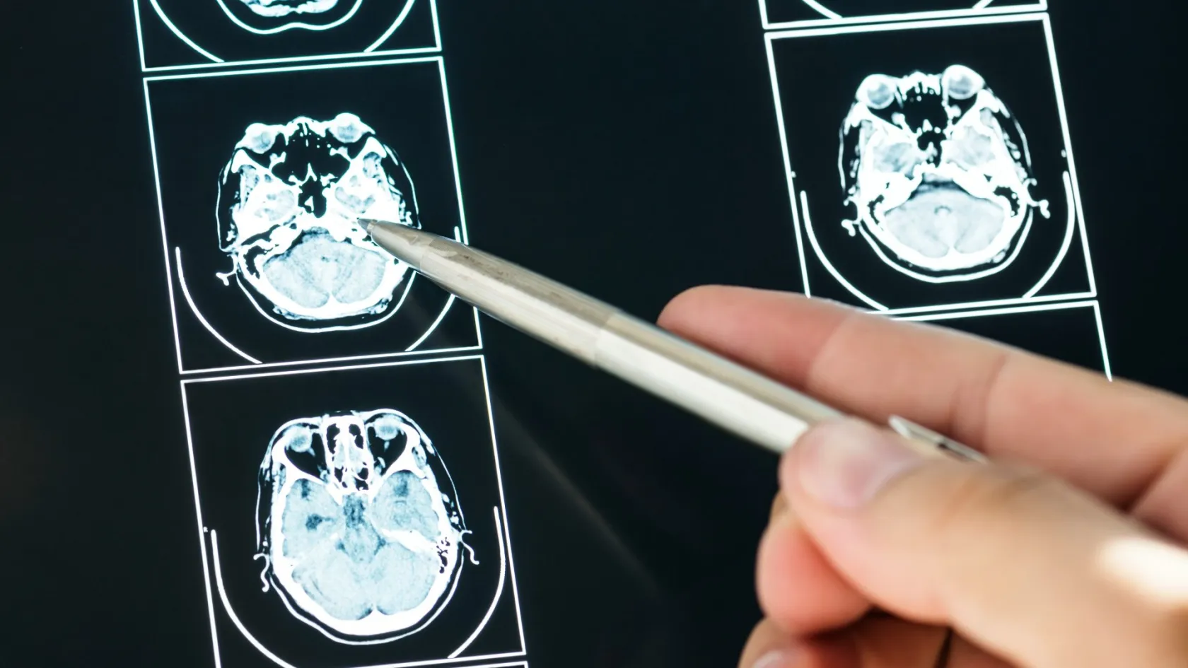 Dotatate PET/CT скенер - образна диагностика на невроендокринни тумори